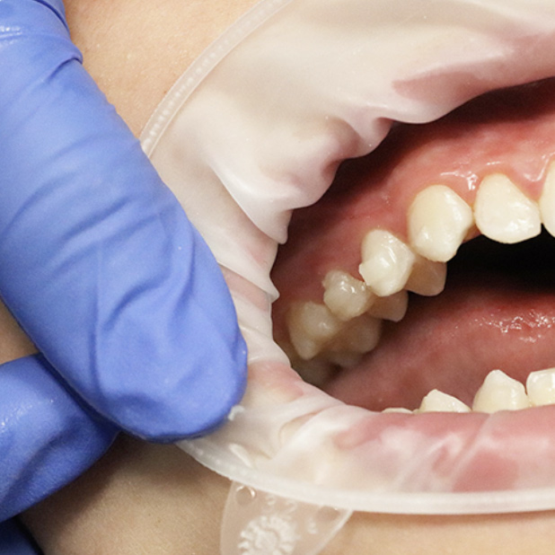 Invisalign Saint John