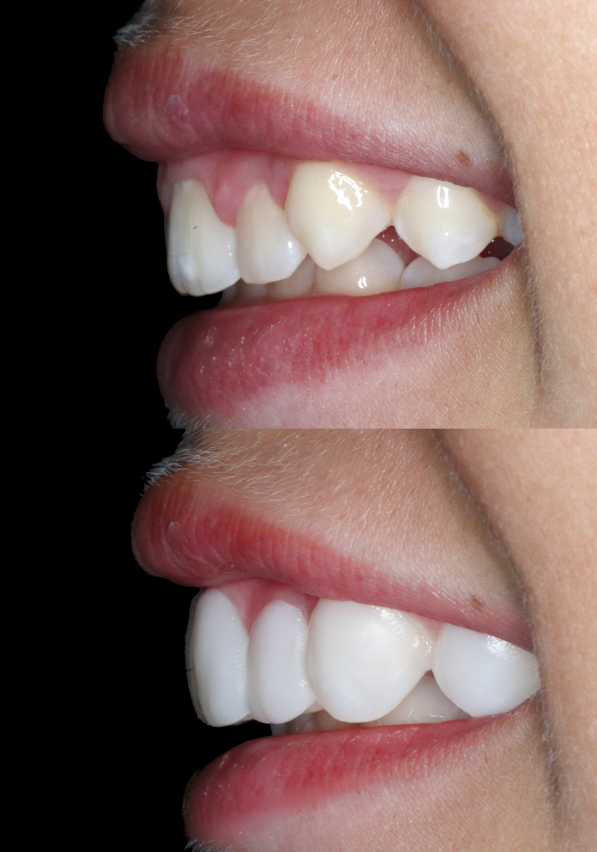 Before And After DSD Try-In Difference