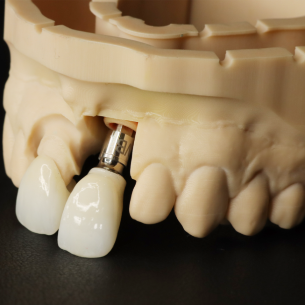 Veneers and Crowns