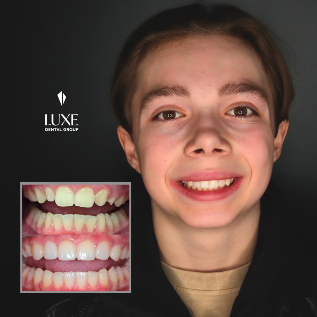 Boy with peg laterals transformation