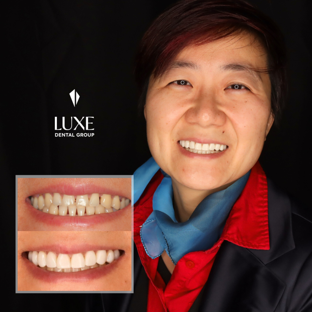 Before & After Invisalign and Bonding