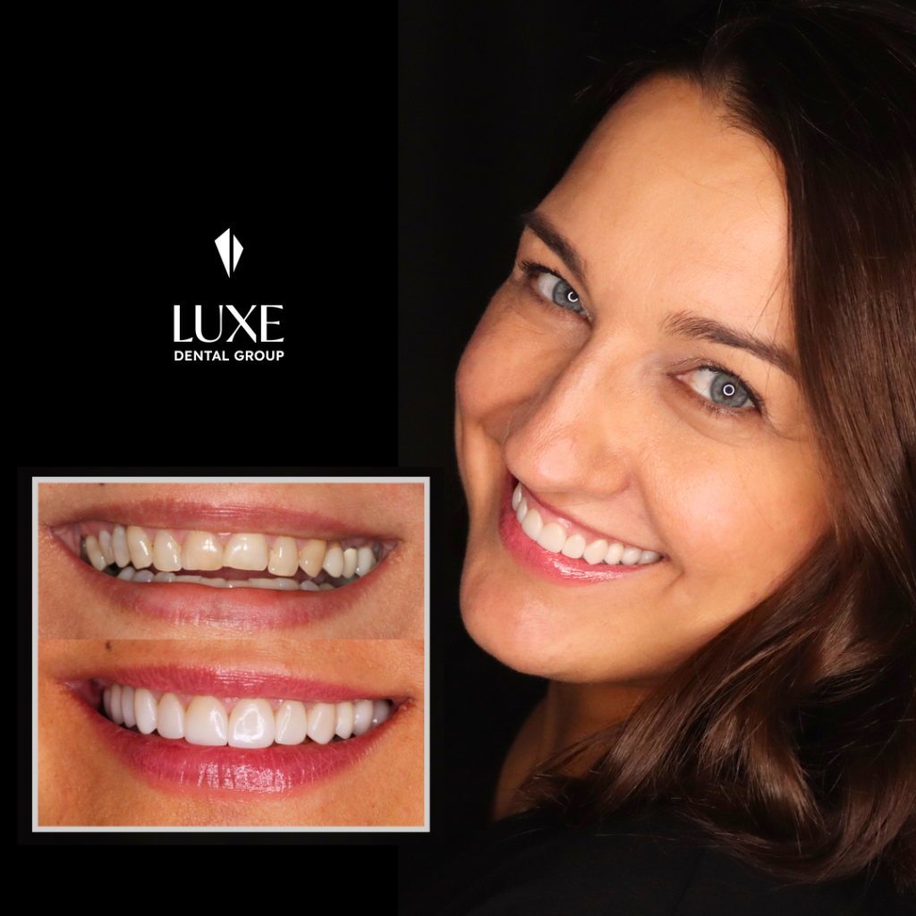 woman after orthodontics, and crowns and veneers